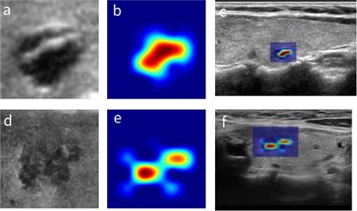 Differential regional importance mapping for thyroid nodule malignancy prediction with potential to improve needle aspiration biopsy sampling reliability